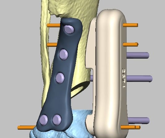 3D-printed limb