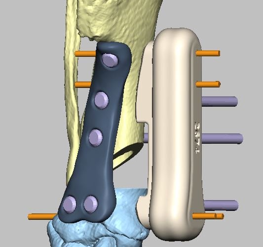 3D-printed limb