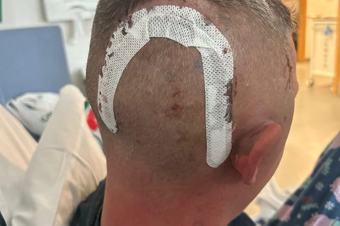 Dan Wyatt had 35 staples in his head after his brain tumour operation. 